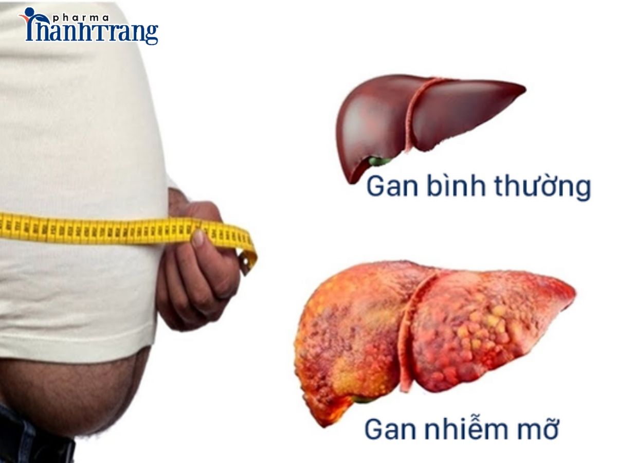 gan nhiễm mỡ